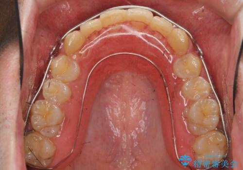 ガタつきの大きい前歯　インビザラインによるマウスピース矯正治療の治療後