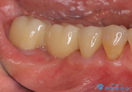 分岐部 Ⅲ 度病変による抜歯　小矯正後のブリッジ治療の治療後