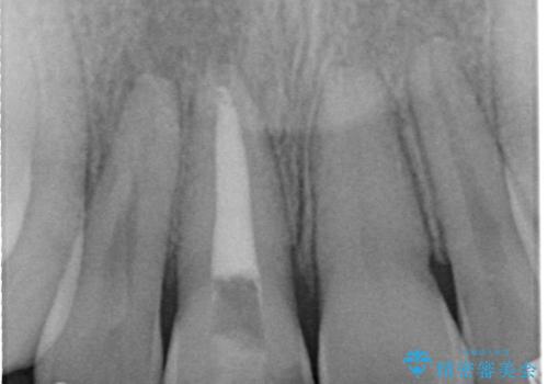【ホワイトニング】右上前歯の歯茎の辺りが暗いのが気になる。の治療前