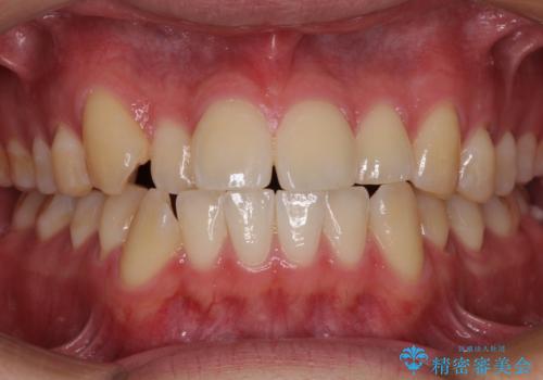 八重歯と前歯のクロスバイト　ワイヤー装置で短期間矯正の症例 治療前