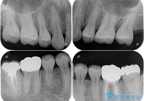抜歯矯正の後戻りでできたスペース インビザライン矯正とセラミック治療の治療後