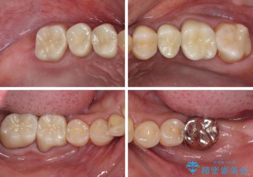 治療中放置してしまった奥歯 セラミック治療の治療後