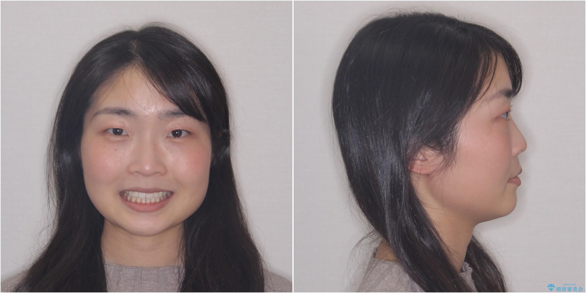 【モニター】気になる八重歯を素早く改善 ワイヤー装置での抜歯矯正の治療後(顔貌)