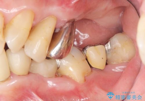 [ 歯周病による多数歯の欠損 ]   全顎的インプラント・歯周病治療の治療前