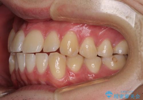 八重歯と前歯のクロスバイト ワイヤー装置で短期間矯正の治療前
