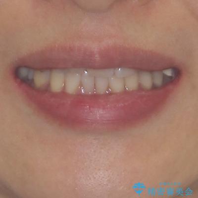 インビザラインは面倒くさい 目立たないワイヤー装置による矯正治療の治療前(顔貌)