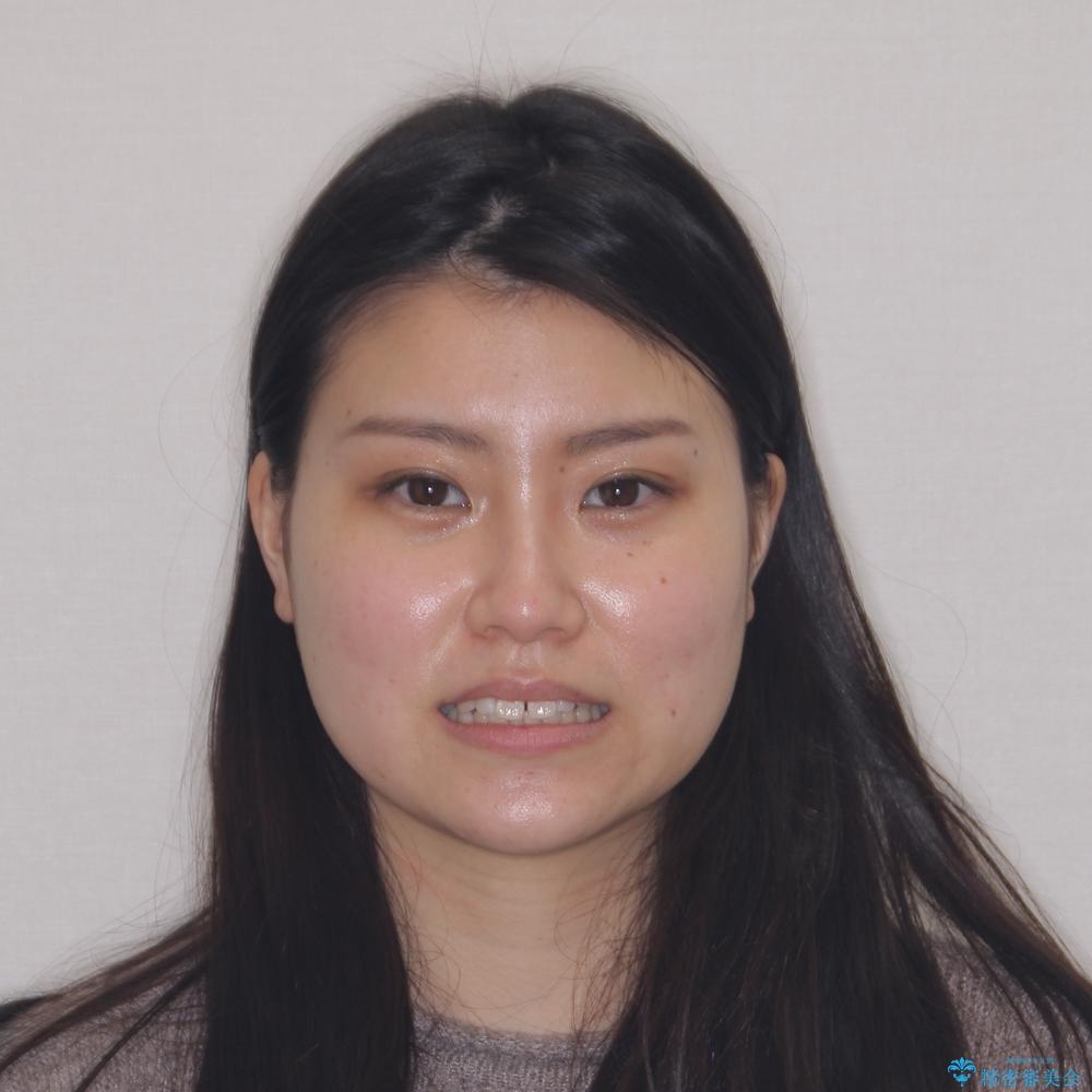 【モニター】すきっ歯をインビザラインで解消の治療前(顔貌)