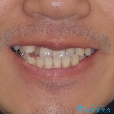 前歯のクロスバイトを改善　インビザライン矯正の治療前（顔貌）