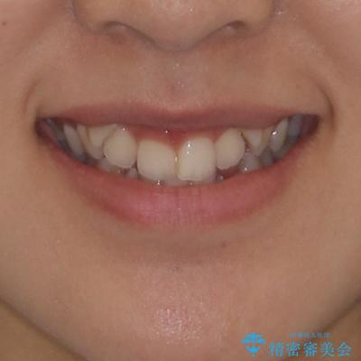 著しい八重歯が気になる インビザラインでの矯正治療の治療前(顔貌)