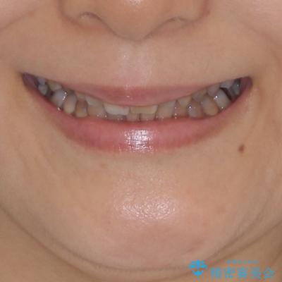 咬み合わせを治したい インビザラインによる矯正治療の治療前(顔貌)