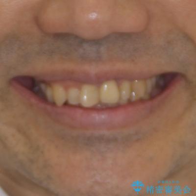 欠損歯列の矯正治療とインプラント治療の治療前（顔貌）
