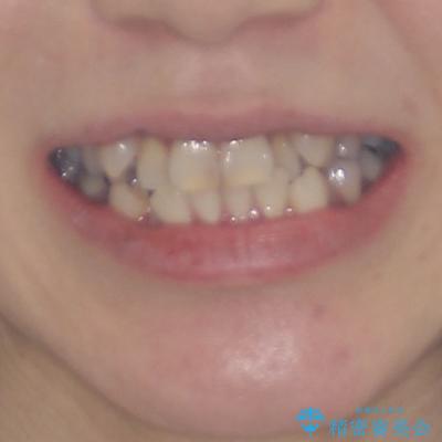 気になる八重歯を目立たない装置で改善　ハーフリンガル矯正の治療前（顔貌）