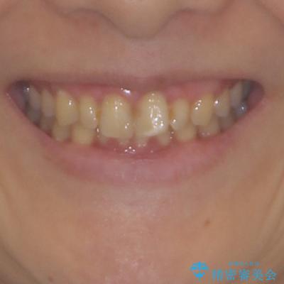 前歯のデコボコと奥歯のクロスバイト　インビザラインで改善の治療前（顔貌）