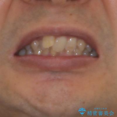 前歯が折れたついでに歯並びも改善　矯正治療と前歯のセラミック治療の治療前（顔貌）