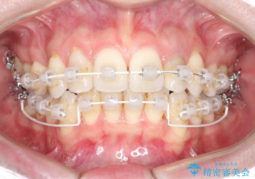 【ワイヤー矯正】歯のガタガタをなおしたいの治療中