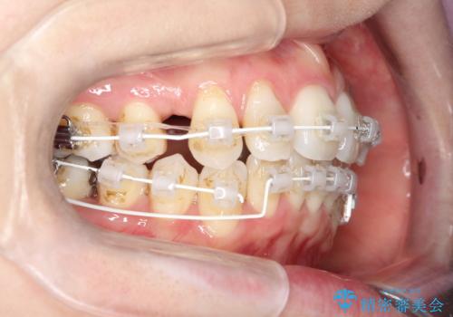 【ワイヤー矯正】歯のガタガタをなおしたいの治療中
