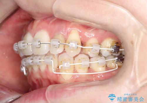 【ワイヤー矯正】歯のガタガタをなおしたいの治療中