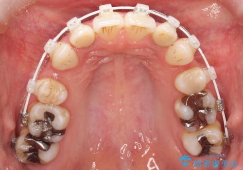 【ワイヤー矯正】歯のガタガタをなおしたいの治療中