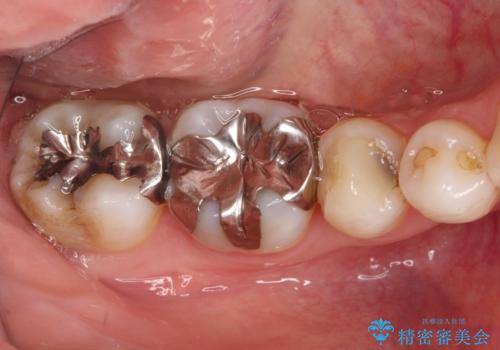 【オールセラミッククラウン】被せ物の治療の症例 治療前