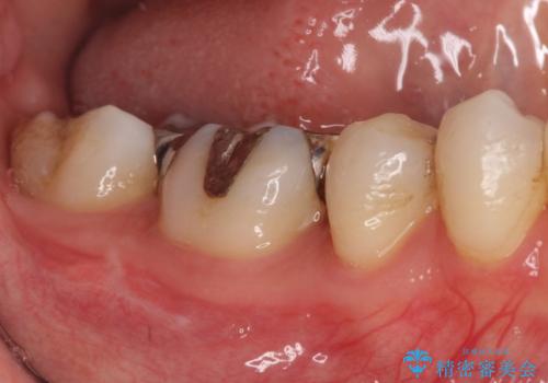 【オールセラミッククラウン】被せ物の治療の治療前