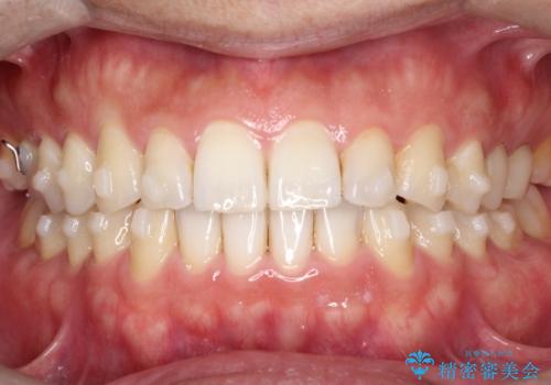 【インビザライン】前歯の隙間を閉じたいの治療中