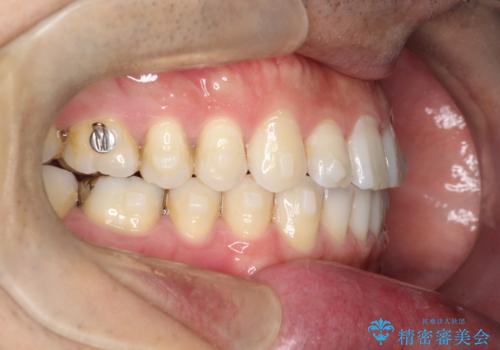 【インビザライン】前歯の隙間を閉じたいの治療中