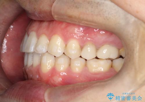 【インビザライン】前歯の隙間を閉じたいの治療中