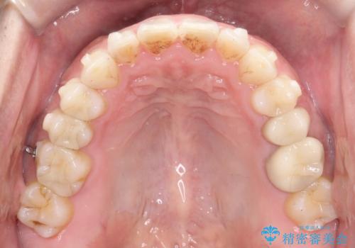 【インビザライン】前歯の隙間を閉じたいの治療中