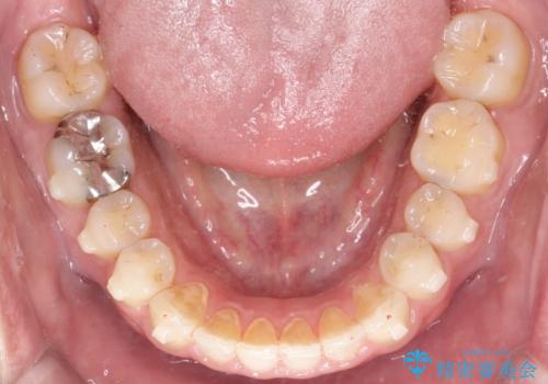 【インビザライン】前歯の隙間を閉じたいの治療中