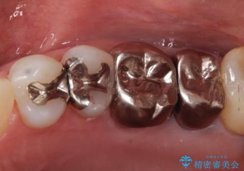 【セラミックインレー】再治療を防ぐ虫歯治療の症例 治療前