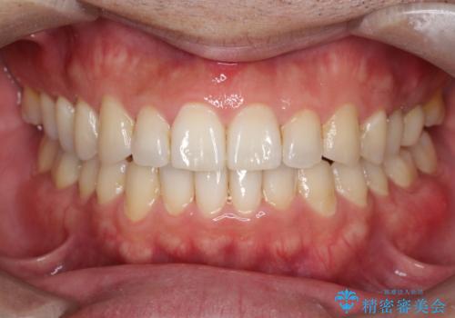 【インビザライン】前歯の隙間を閉じたいの症例 治療後