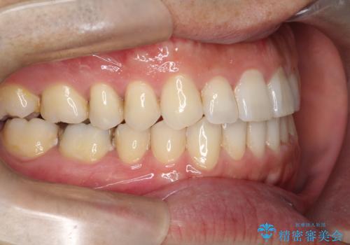【インビザライン】前歯の隙間を閉じたいの治療後