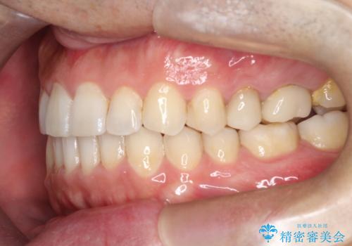 【インビザライン】前歯の隙間を閉じたいの治療後