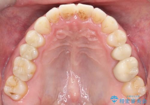 【インビザライン】前歯の隙間を閉じたいの治療後