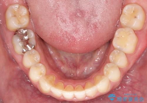 【インビザライン】前歯の隙間を閉じたいの治療後