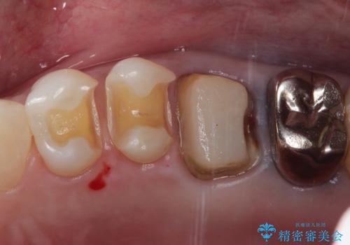 【セラミックインレー】再治療を防ぐ虫歯治療の治療中