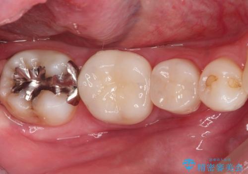 【オールセラミッククラウン】被せ物の治療の症例 治療後