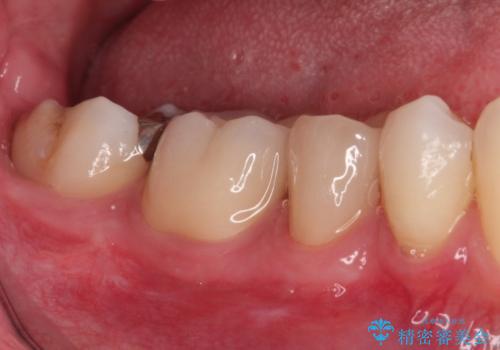 【オールセラミッククラウン】被せ物の治療の治療後