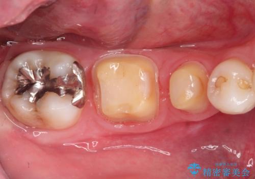 【オールセラミッククラウン】被せ物の治療の治療中