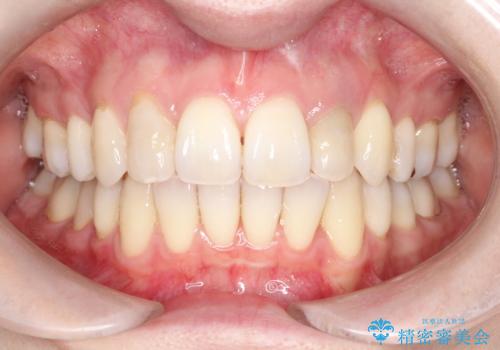 【ワイヤー矯正】歯のガタガタをなおしたいの治療後