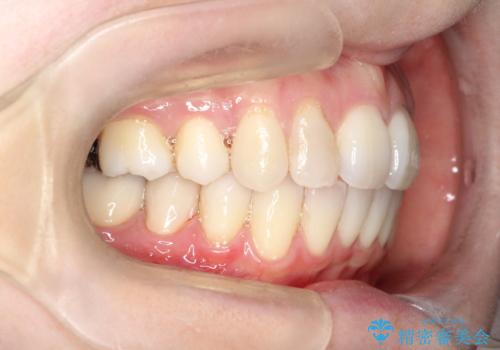 【ワイヤー矯正】歯のガタガタをなおしたいの治療後