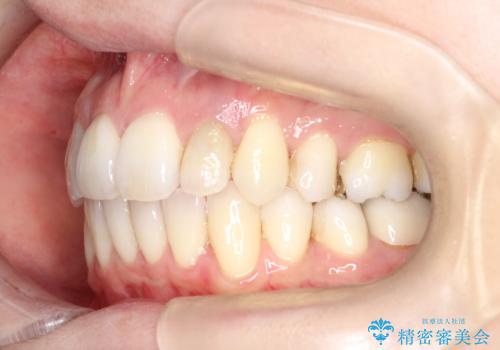 【ワイヤー矯正】歯のガタガタをなおしたいの治療後