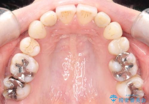 【ワイヤー矯正】歯のガタガタをなおしたいの治療後