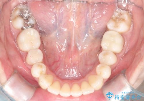 【ワイヤー矯正】歯のガタガタをなおしたいの治療後