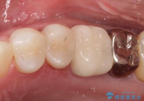【セラミックインレー】再治療を防ぐ虫歯治療の症例 治療後