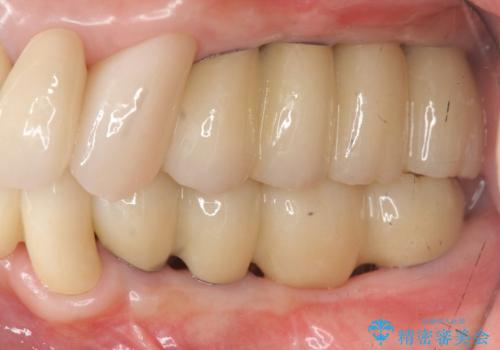 [ 歯周病による多数歯の欠損 ]   全顎的インプラント・歯周病治療の治療後