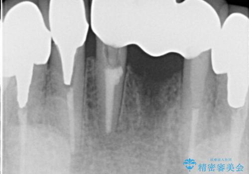 前歯が一本取れた オールセラミックブリッジによる補綴治療の治療後
