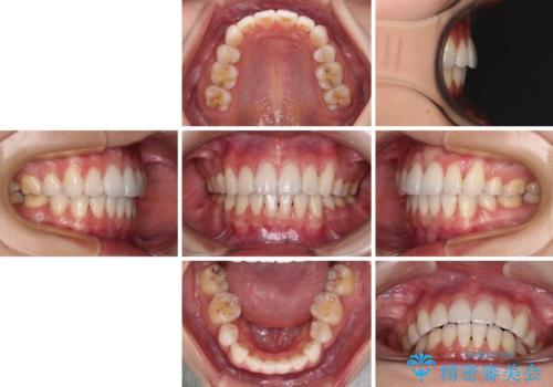 【モニター】気になる八重歯を素早く改善 ワイヤー装置での抜歯矯正の治療後