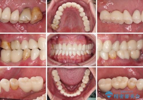 憧れの白い歯に　全顎セラミック治療の治療後