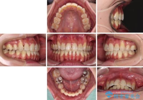 気になる八重歯を目立たない装置で改善　ハーフリンガル矯正の治療後